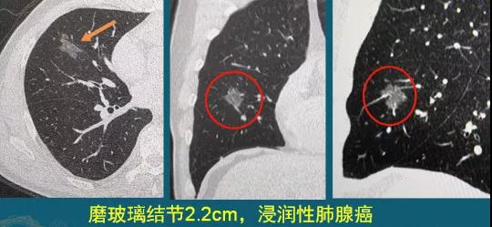 肺磨玻璃結節(jié)