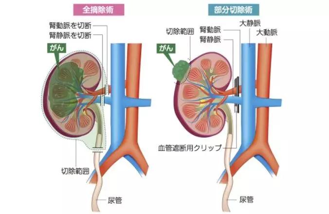 腎癌手術(shù)治療