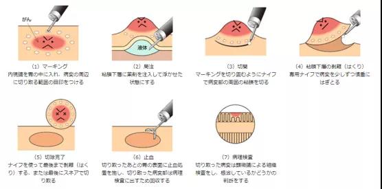 內(nèi)鏡治療胃癌和腸癌