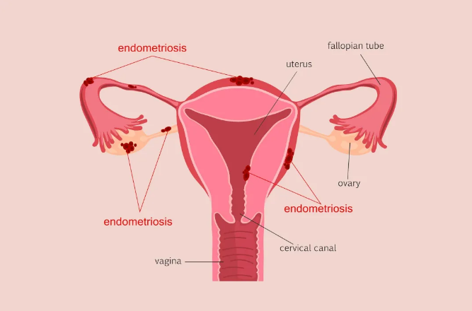 婦科腫瘤篩查