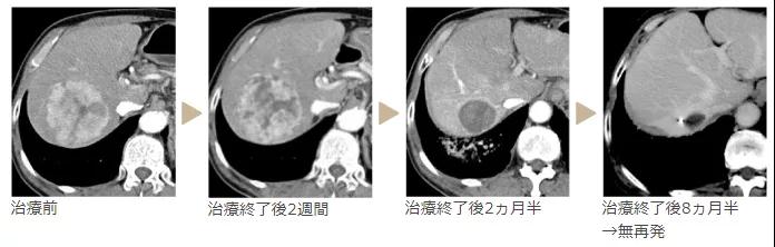 質子治療肝癌