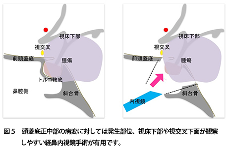 內(nèi)窺鏡顱底手術(shù)