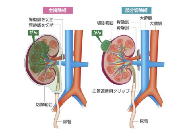 腎癌手術(shù)治療