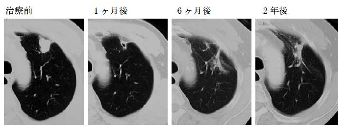 肺癌質(zhì)子重離子治療