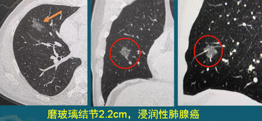 肺磨玻璃結(jié)節(jié) 肺癌