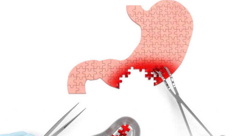 日本胃癌手術(shù) 日本胃癌手術(shù)