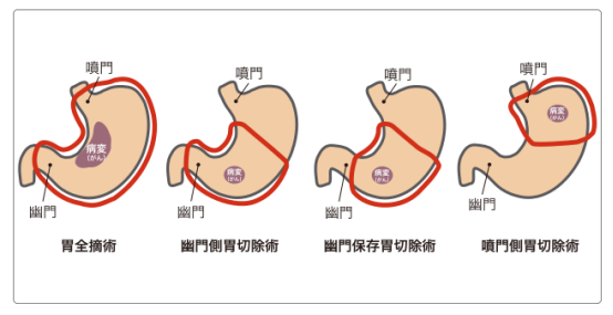 胃癌日本看病