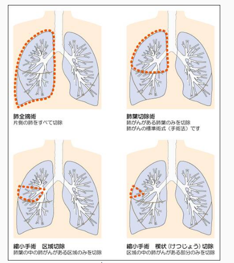 早期肺癌手術(shù)方案效果