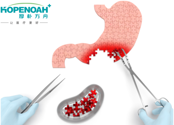 日本胃癌治療效果 日本胃癌治療效果