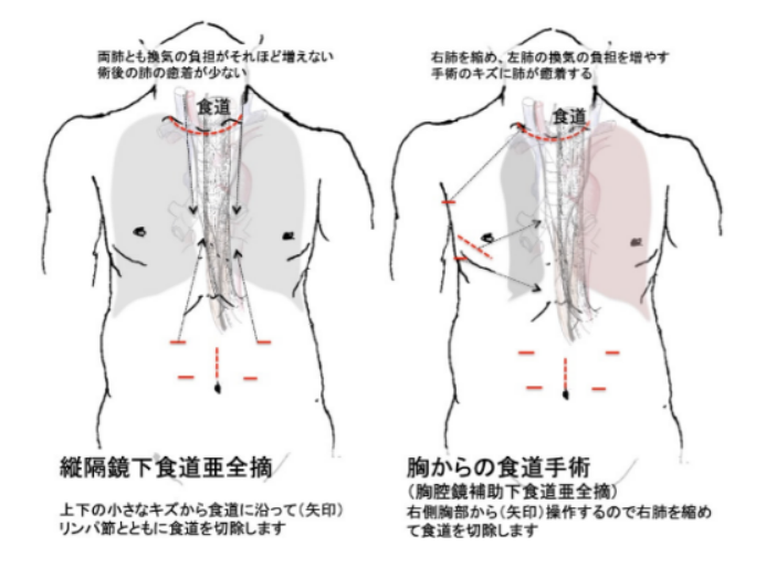 食道癌出國(guó)看病優(yōu)勢(shì)