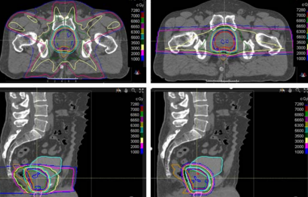 前列腺癌放療